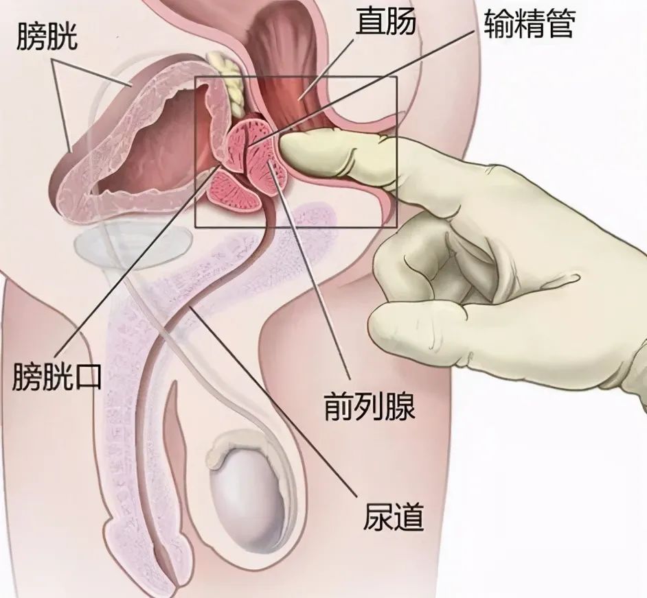 前列腺炎与阳痿，早泄，射精无力不得不说的事(图1)